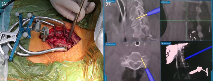 Subaxial Cervical Spine Fracture Dislocation Fixation — Fig. 1