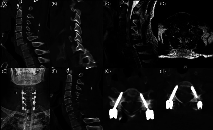 Subaxial Cervical Spine Fracture Dislocation Fixation — Fig. 2