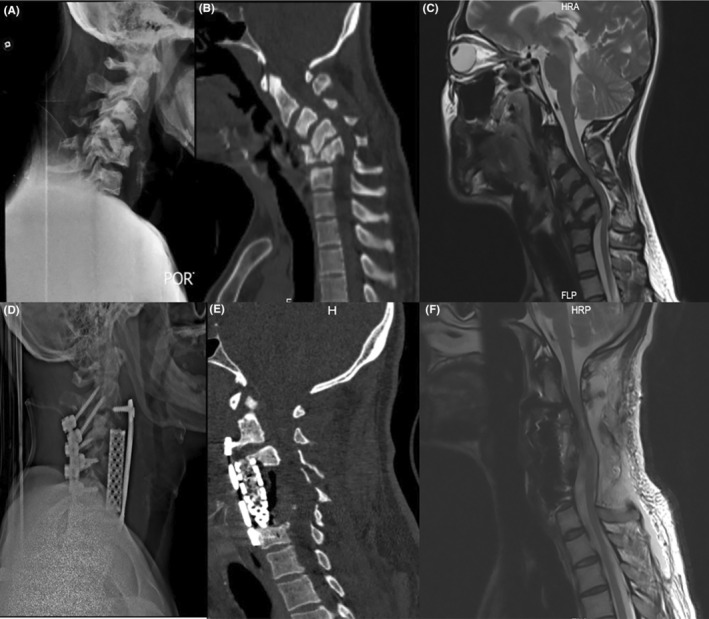 Subaxial Cervical Spine Fracture Dislocation Fixation — FIGURE 1