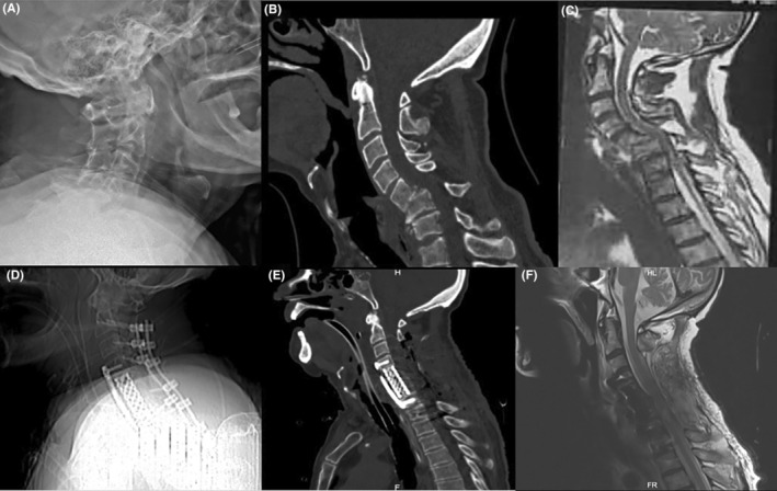 Subaxial Cervical Spine Fracture Dislocation Fixation — FIGURE 2