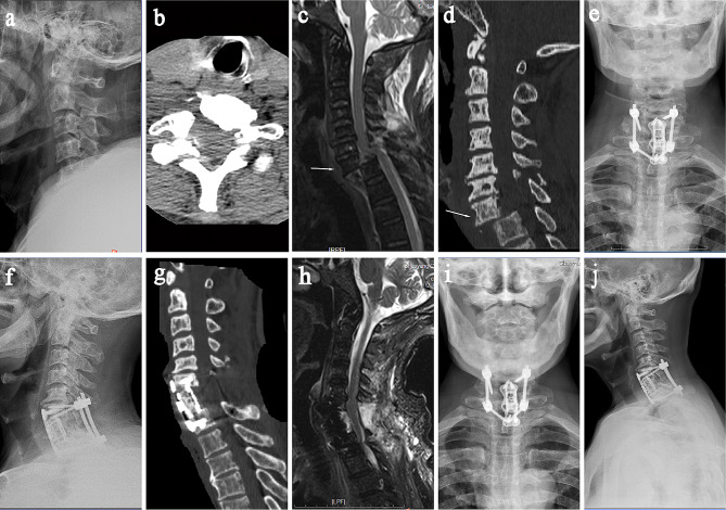 Subaxial Cervical Spine Fracture Dislocation Fixation — Fig. 1
