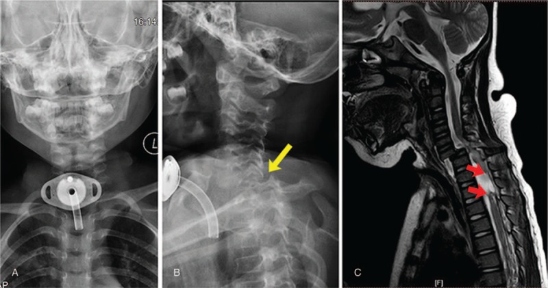 Subaxial Cervical Spine Fracture Dislocation Fixation — Figure 1