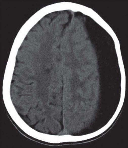 Subduroperitoneal Shunt Placement — Figure 1