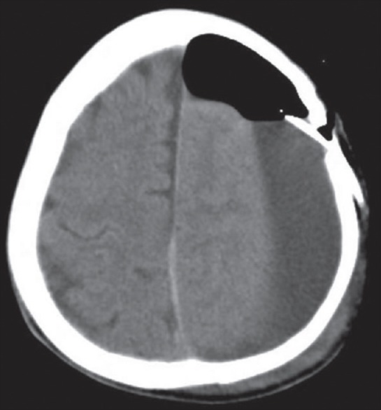 Subduroperitoneal Shunt Placement — Figure 2