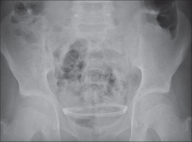 Subduroperitoneal Shunt Placement — Figure 3