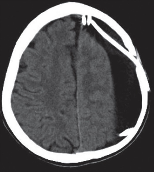 Subduroperitoneal Shunt Placement — Figure 4