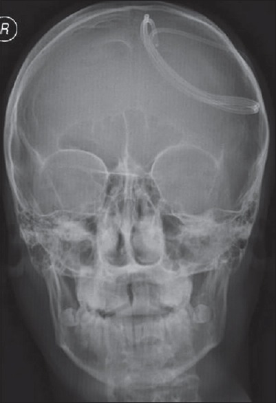 Subduroperitoneal Shunt Placement — Figure 5