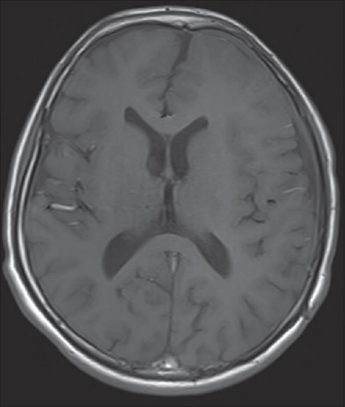 Subduroperitoneal Shunt Placement — Figure 6