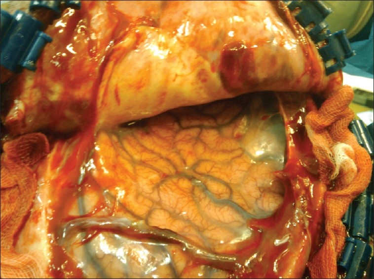 Subduroperitoneal Shunt Placement — Figure 2