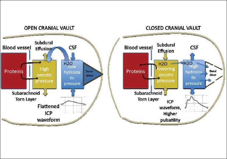 Subduroperitoneal Shunt Placement — Figure 3