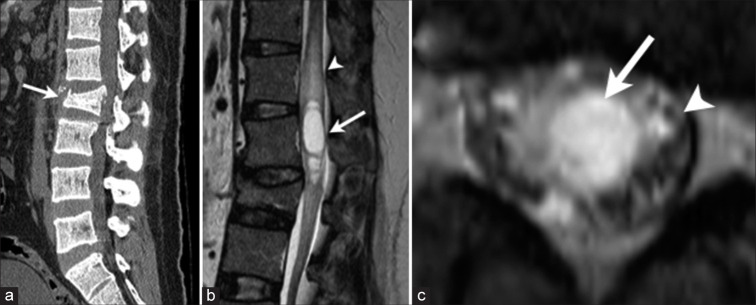 Syringomyelia Management Syringosubarachnoid Shunt — Figure 1: