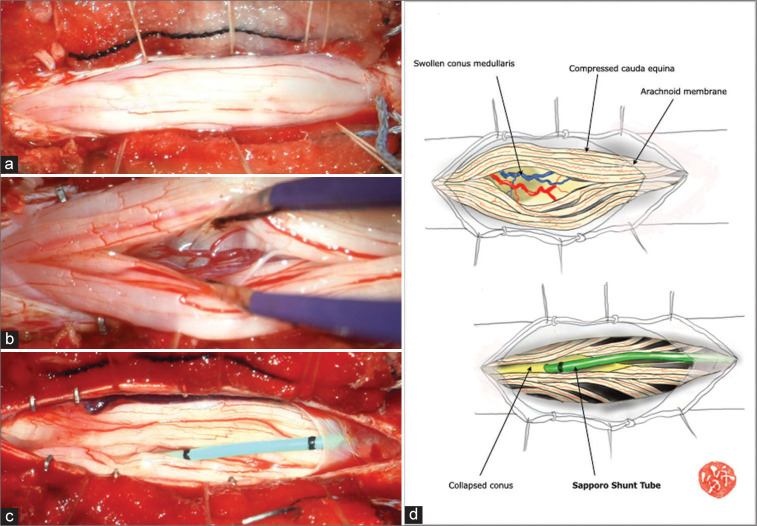 Syringomyelia Management Syringosubarachnoid Shunt — Figure 2: