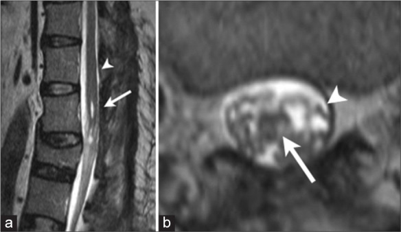 Syringomyelia Management Syringosubarachnoid Shunt — Figure 3: