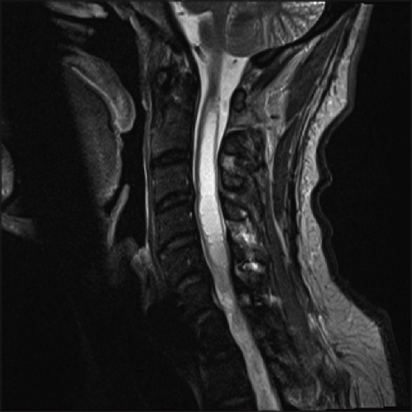 Syringomyelia Management Syringosubarachnoid Shunt — Figure 1