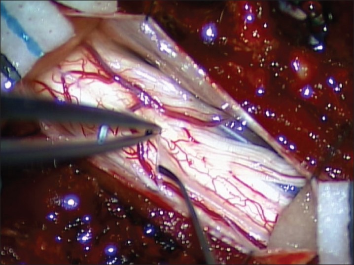 Syringomyelia Management Syringosubarachnoid Shunt — Figure 1