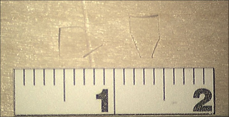 Syringomyelia Management Syringosubarachnoid Shunt — Figure 2