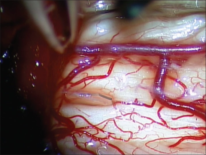 Syringomyelia Management Syringosubarachnoid Shunt — Figure 3