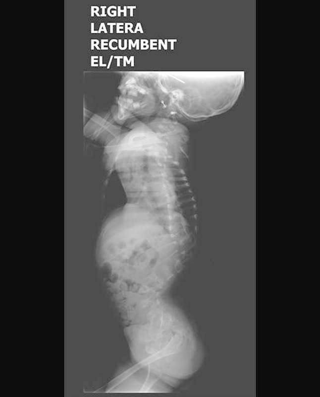 Tethered Cord Release — Fig. 3