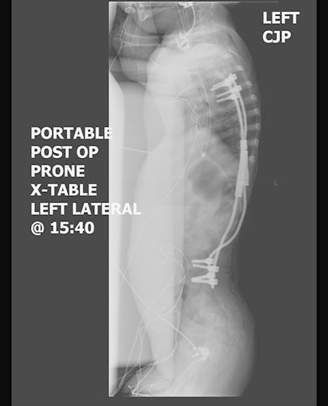 Tethered Cord Release — Fig. 4