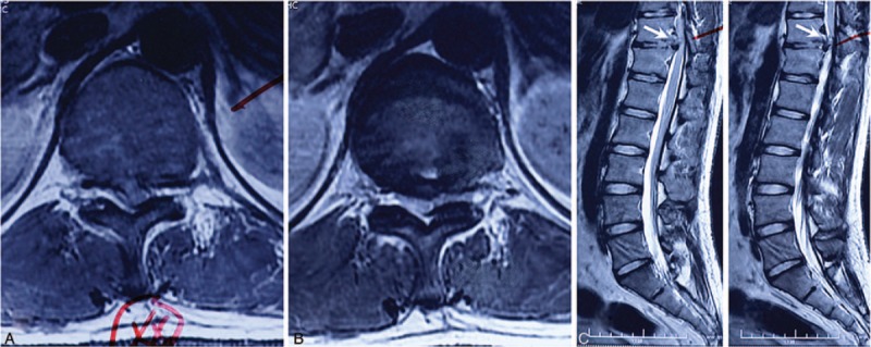 Thoracic Discectomy — Figure 1