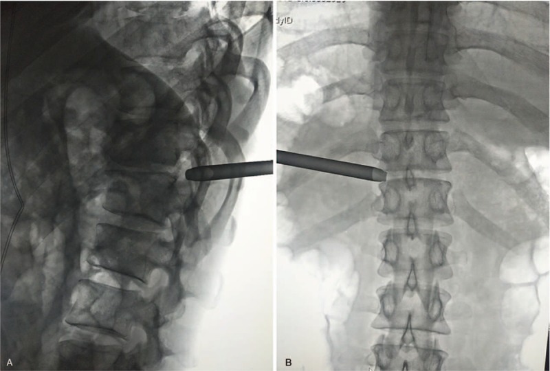 Thoracic Discectomy — Figure 2