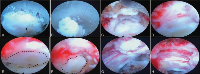 Thoracic Discectomy — Figure 3