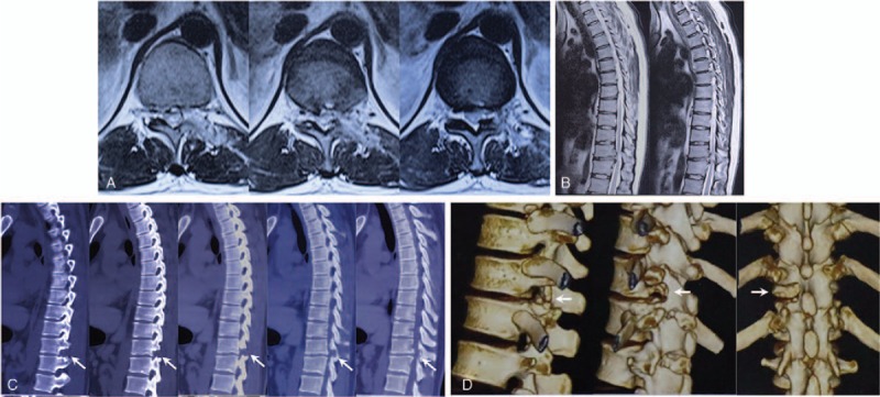 Thoracic Discectomy — Figure 4