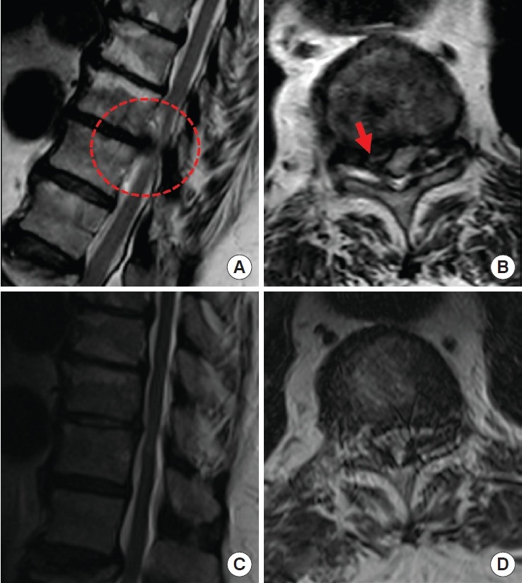 Thoracic Discectomy — Fig. 1.