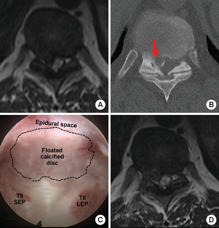 Thoracic Discectomy — Fig. 2.