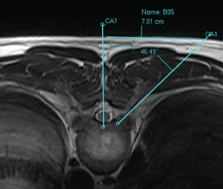 Thoracic Discectomy — Fig. 3.