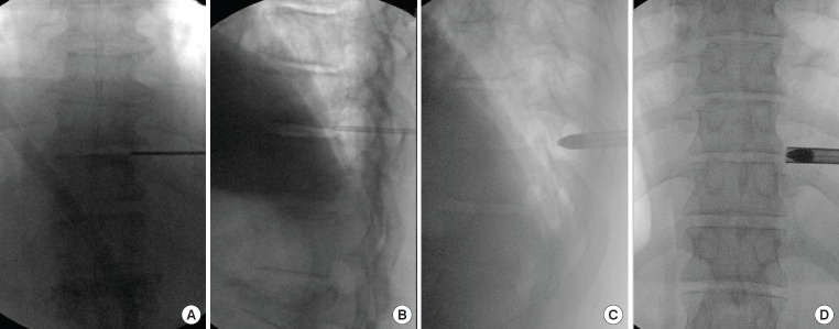 Thoracic Discectomy — Fig. 4.