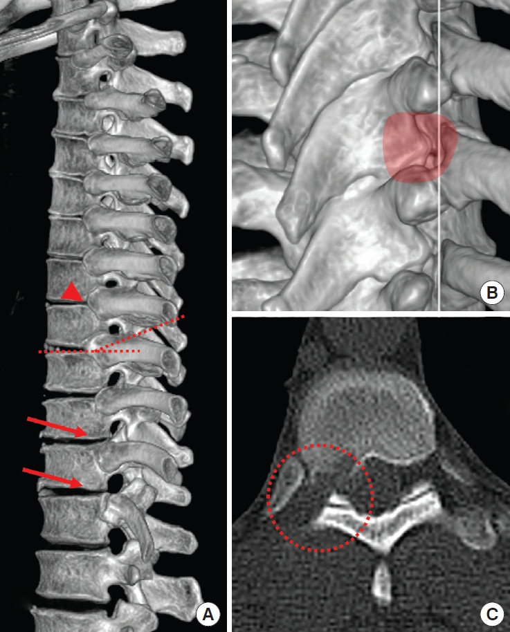 Thoracic Discectomy — Fig. 5.