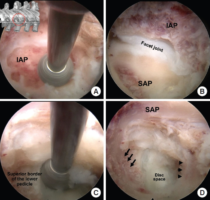 Thoracic Discectomy — Fig. 6.