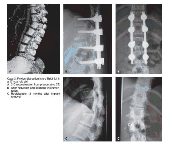 Thoracolumbar Burst Fracture Fixation — Figure 7