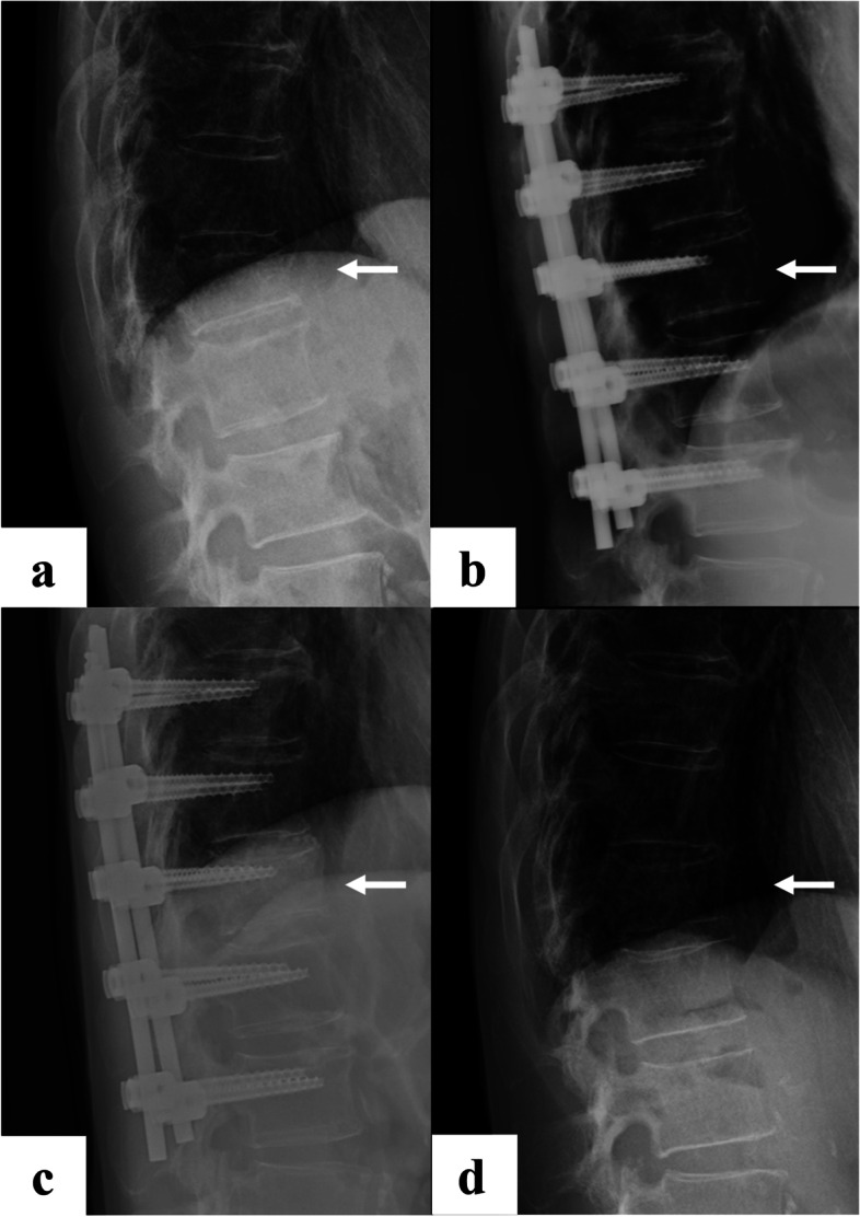 Thoracolumbar Burst Fracture Fixation — Fig. 1