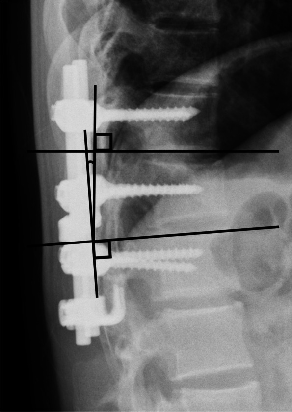 Thoracolumbar Burst Fracture Fixation — Fig. 2