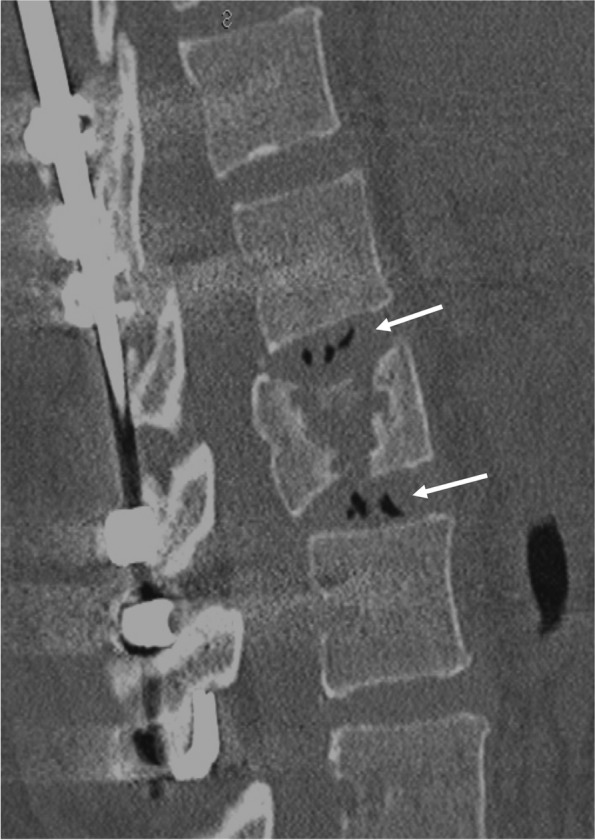 Thoracolumbar Burst Fracture Fixation — Fig. 3