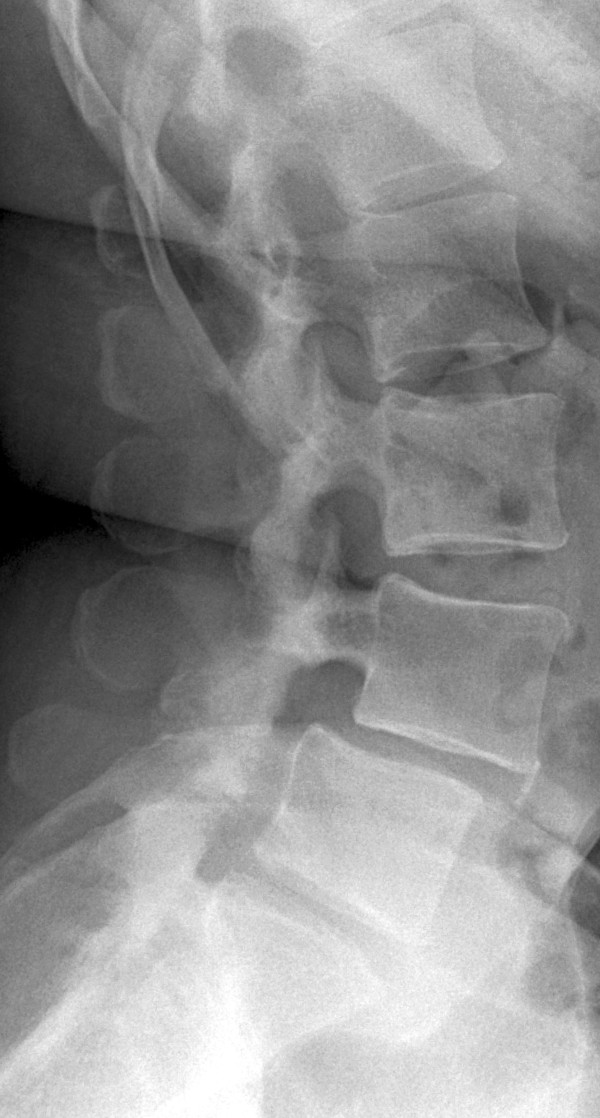 Transforaminal Lumbar Interbody Fusion — Figure 1