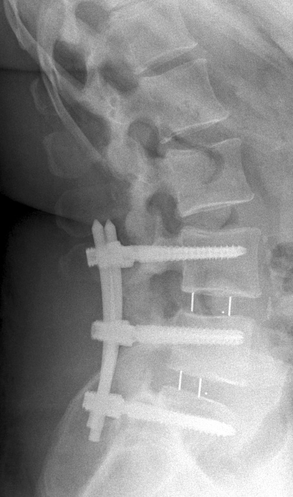 Transforaminal Lumbar Interbody Fusion — Figure 2