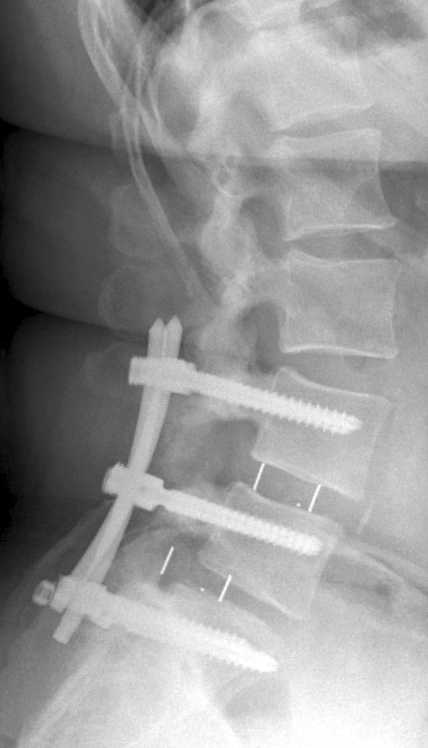 Transforaminal Lumbar Interbody Fusion — Figure 3