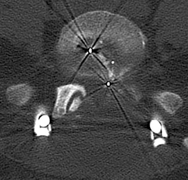Transforaminal Lumbar Interbody Fusion — Figure 4