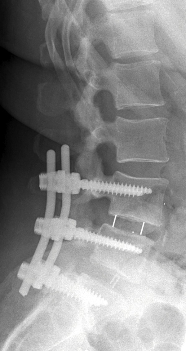 Transforaminal Lumbar Interbody Fusion — Figure 5