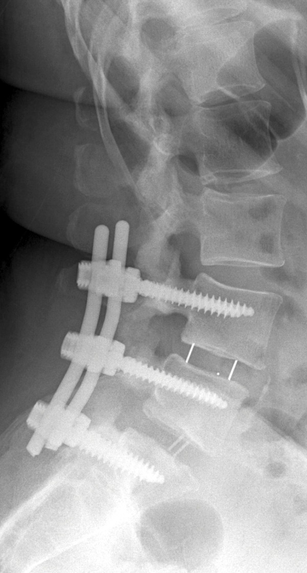Transforaminal Lumbar Interbody Fusion — Figure 6