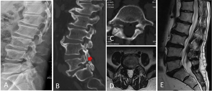Transforaminal Lumbar Interbody Fusion — Figure 1