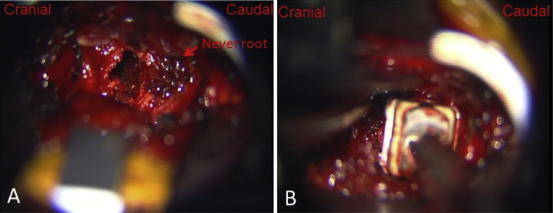 Transforaminal Lumbar Interbody Fusion — Figure 2