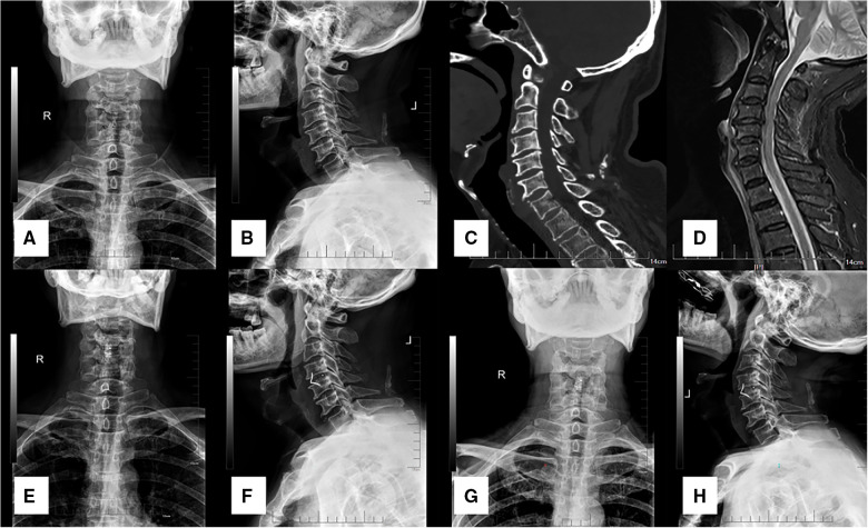 Traumatic Central Cord Syndrome — Figure 1