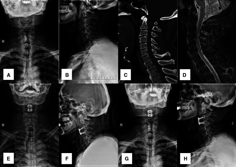 Traumatic Central Cord Syndrome — Figure 2