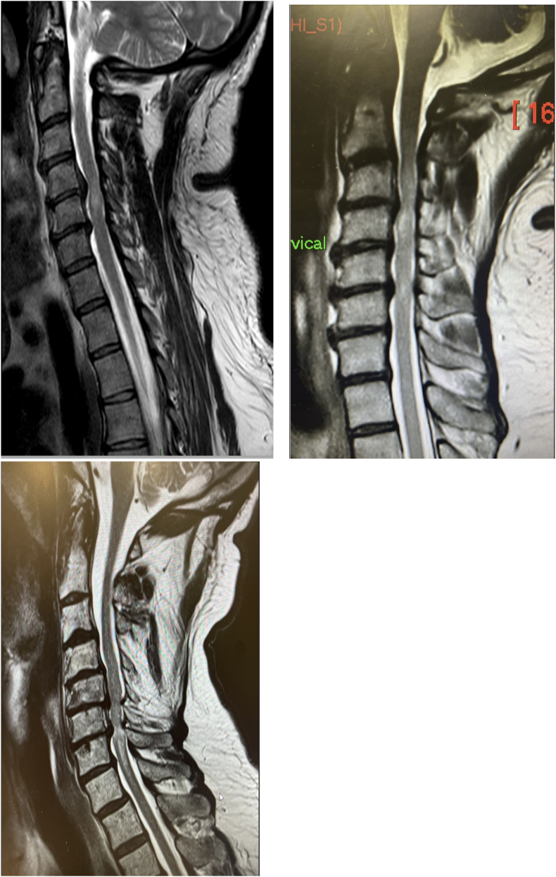 Traumatic Central Cord Syndrome — Fig. 2