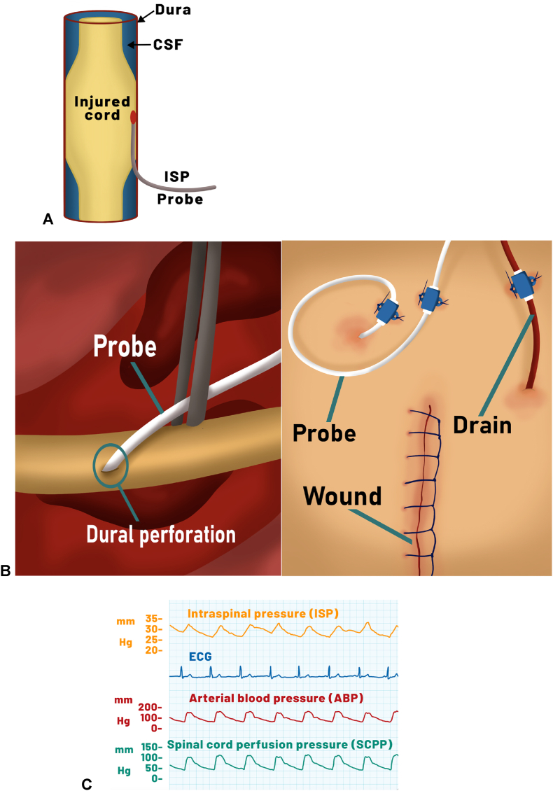 Traumatic Central Cord Syndrome — Fig. 3