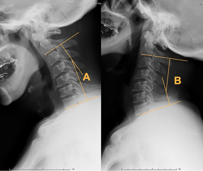 Traumatic Central Cord Syndrome — Figure 1